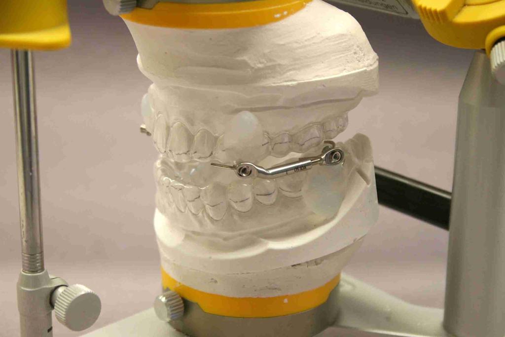 Working models with pressure formed foils are set back into the articulator. Anchorage elements are fixed with Sil-Kitt (Fa.