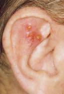 Arch Dermatol 2004 Wu et al. Australas J Dermatol 2004 Systemische Reaktionen (<5% der Pat.) Grippe-artige Symptome Kopfschmerzen (4.
