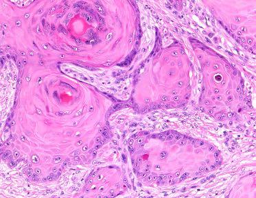 Karzinom - Befundung Spinozelluläres Karzinom - Pathogenese Histologischer Befund: Differenzierungsgrad, Invasionstiefe, Tumordicke (mm) Mässig differenziertes Carcinoma spinocellulare, bis ins