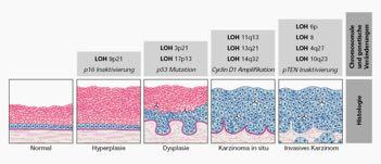 Spinozelluläres Karzinom - Pathogenese UV B Spinozelluläres Karzinom - Pathogenese UV B Induktion and Aufregulation von Epidermal Growth Factor Receptor (EGFR) p53
