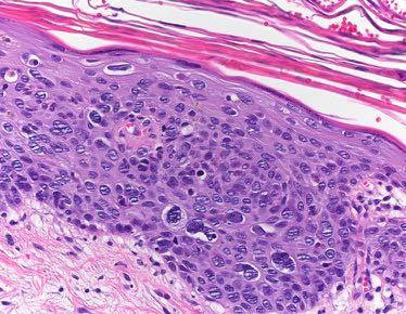 Epitheliale Tumoren Klinik und Histologie Aktinische Keratose Diagnostik à Probeexzision Eindringtiefe 4mm Metastasierungsrisiko 6-20% Präkanzerose (Carcinoma in situ) oder invasiv wachsendes