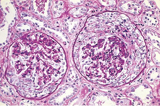EPGN RPGN Histologie Klinisches Bild Extrakapillär-proliferative Glomerulonephritis (EPGN) Entzündliche Infiltrate Halbmonde