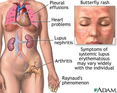 Mit Lungenbeteiligung = Goodpasture-Syndrom - Postinfektiös -