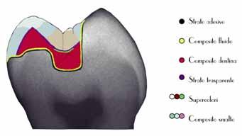 Effekte zu vermeiden, die bei kräftigen Farben häufig auftreten (siehe z.b. Abb. 7). Abb. 4 und 5 Die grafische Darstellung des vorgestellten Schichtschemas Nach Applizieren des Schmelz- Dentin-Adhäsivs (z.