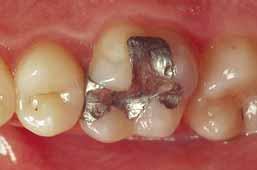 Abb. 12 Dritter Patientenfall: Großflächige Amalgamfüllung eines OK-Molaren Abb. 13 Präparierter Zahn Abb.