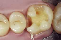 16 Vierter Patientenfall: Kariöse Läsionen im Molaren und Prämolarenbereich unteren Schichten verwendeten Komposits besitzen.