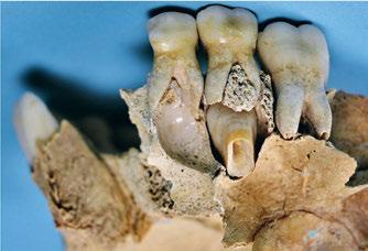 Fotos: Kloster Lorsch Die Überreste geben Aufschluss darüber, welches Alter der Mensch erreichte und an welchen Zahnkrankheiten er im Laufe seines Lebens gelitten hat (oben: Zahndurchbruch, unten: