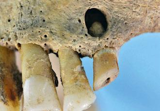 Bei den gut 110 Individuen, deren Skelettreste im Verlauf der letzten 120 Jahre bislang auf dem Klosterareal geborgen und untersucht wurden, geben die Zähne mit die besten Hinweise darauf, wie die