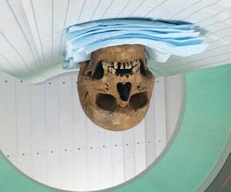 Das Körperskelett konnte bei den Ausgrabungen nicht geborgen werden. Der Befund: Parodontitis, Karies und Zahnstein Die Datierung ergab ein Alter von 1133 ±24 Jahren BP.