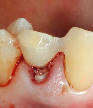 40 Zahnmedizin Bei anschließender Zahnentfernung folgen weitere Schritte: Behandlungsschritte 9 10 11 12 13 Quelle: Mörig et al.