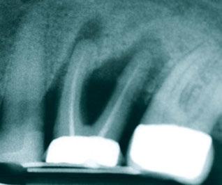 42 Zahnmedizin Abbildung 8: Die Abbildung zeigt zu Beginn der forcierten Extrusion eine massiv ausgeprägte Osteolyse an Zahn 36 mit Furkationsund Lockerungsgrad III bei Pusaustritt.