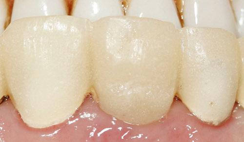 Fall 2: Socket Preservation ohne Fremdmaterialien Nachdem imrahmen einer Gesamtsanierung Zahn 21 nicht erhaltungswürdig gewesen ist, erfolgte eine forcierte Extrusion beginnend mit rund 700 cn mit