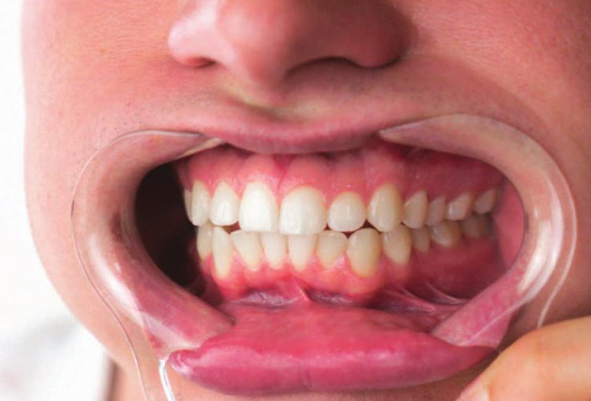 Untere Zähne Stelle sicher, dass der Lippenspreizer immer noch in deinem Mund ist.