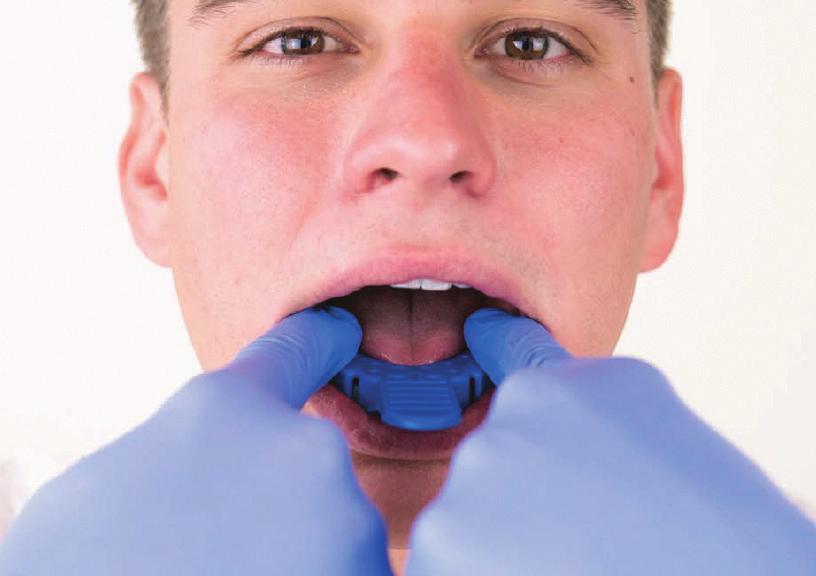 gemixt ist und in den Abdrucklöffel platziert wurde: Mund entnehmen kannst. Insbesondere bei Patienten mit festsitzenden Brücken kann dieser Vorgang etwas länger dauern.