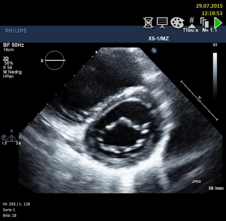 RV-Dilatation -> LV-Exzentrizität