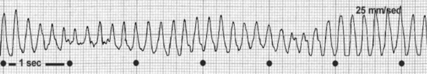 Auffällige EKG-Befunde