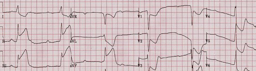 Auffällige EKG-Befunde
