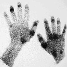 Synovialitistypische Anreicherung im rechten Kniegelenk (Recessus suprapatellaris). Beim Rheumatiker fände man ein identisches Bild. Abb. 3.14 Die Hand als Visitenkarte des Rheumatikers.