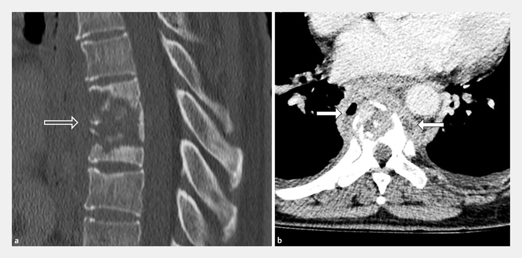 Abb. 6 CT-Morphologie der Spondylodiszitis. Die im Knochenfenster sagittal rekonstruierte BWS in a zeigt eine ausgedehnte Destruktion zweier Wirbelkörper ventral betont.