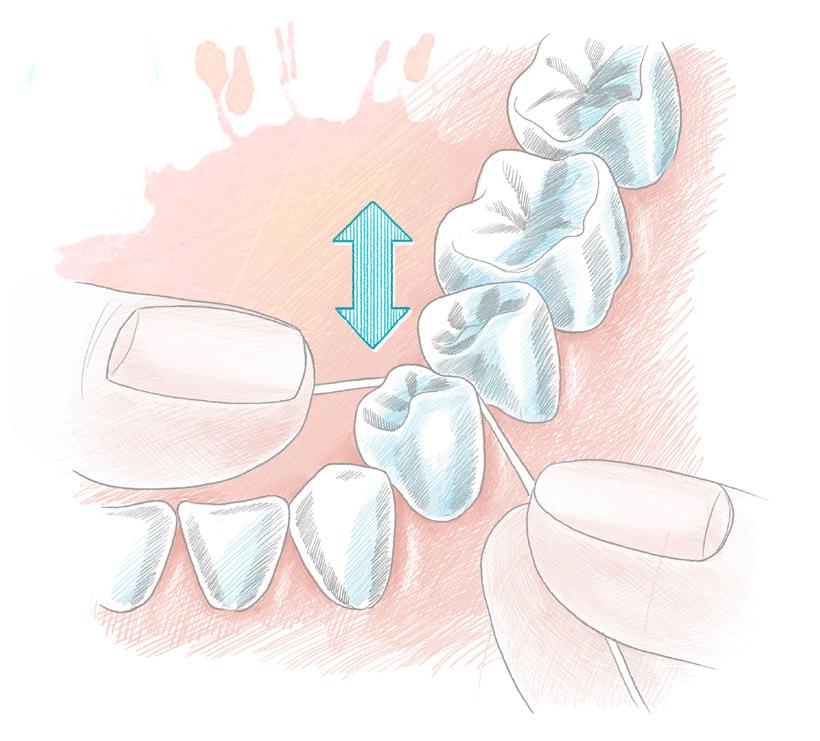 3. Zahnseide für Problemzonen In den Zahnzwischenräumen können sich Bakterien gut vor der Zahnbürste verstecken.