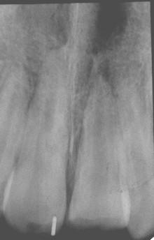 Intrusion wird oft beim Tempotrauma beobachten wie zum Beispiel Autounfall, Fahrradsturz oder beim Skifahren. Hier wird der Zahn in den Kieferknochen hineingeschlagen und erscheint somit verkürzt.