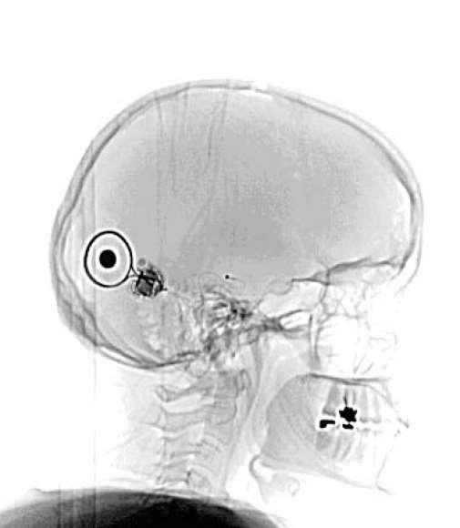 html Cochlea-Implantat (CI)
