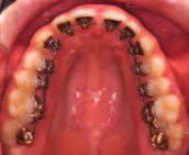 Behandlungsmöglichkeiten 19 biologischen Kräften die Gewebe um den Zahn zum Knochenumbau angeregt. Die Zähne lassen sich so mit den Zahnwurzeln im Knochen bewegen.
