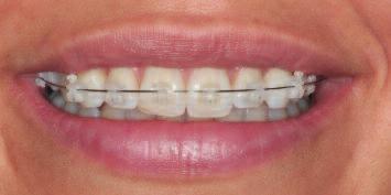 Hierzu zählen zahnfarbene Apparaturen bzw. die Möglichkeit, feste Zahnspangen an den Innenflächen der Zähne zu befestigen (sog.