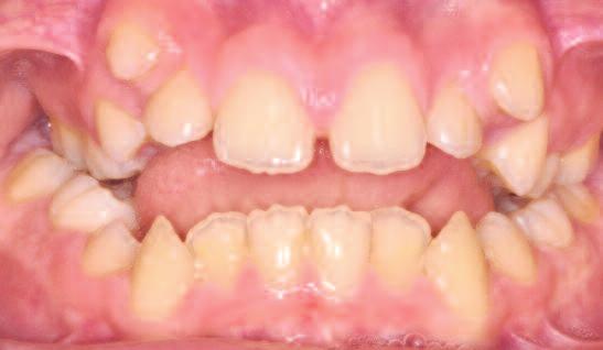 Zahn-/Kieferfehlstellungen und Allgemeingesundheit 3 Offener Biss Der Kieferorthopäde ist ein speziell für das Gebiet der Zahn- und Kieferfehlstellung weitergebildeter und geprüfter Fachzahnarzt.
