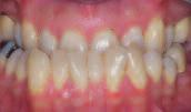 6 Die häufigsten Zahn-/Kieferfehlstellungen Vergrößerter Überbiss/Rückbiss Beim vergrößerten Überbiss ist die Abstützung der unteren Frontzähne an den hinteren Flächen der oberen