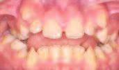 Die häufigsten Zahn-/Kieferfehlstellungen 7 Kreuzbiss Im regelrechten Gebiss sind die oberen Eck- und Backenzähne beim Zusammenbeißen weiter außen als die unteren.