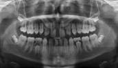 Ursachen dafür sind sowohl Zahnfehlstellungen als auch Wachstumsstörungen von Ober- oder Unterkiefer.