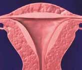 Karzinome Bösartige Veränderungen des Muttermundes oder der Gebärmutterschleimhaut (Karzinome) sind zwar selten, können aber ebenfalls Ursache von Menstruationsstörungen sein.