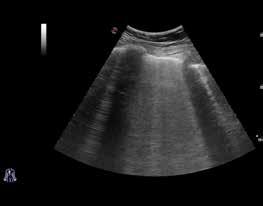 1. Lungenödem Volpicelli et al. International evidence-based recommendations for point-ofcare lung ultrasound.