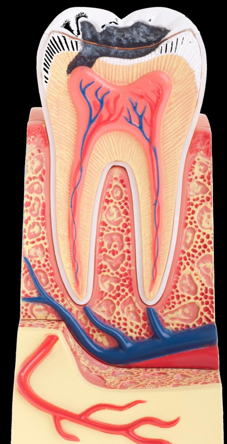 Das Wichtigste zur Wurzelbehandlung auf einen Blick: Wenn ein Zahn stark zerstört oder der Zahnnerv abgestorben ist, gibt es nur zwei Alternativen: Den Zahn zu ziehen oder ihn durch eine