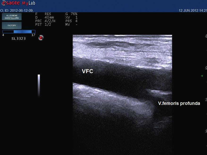 Selten ist die deszendierende Beckenvenenthrombose, bei der das thrombotische Geschehen meistens in der V.