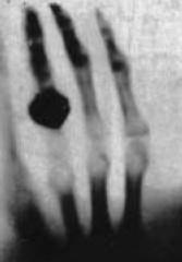 Abb. 11: Erstes Röntrgenbild, aufgenommen am 22.12.1895: linke Hand von Frau Röntgen.