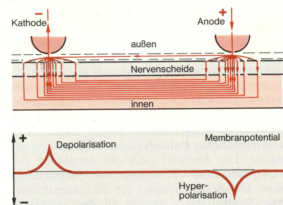 Extrazelluläre Reizelektrode: Kathode Membran Depolarisation Anode Membran Hyperpolarisation Beispiele: Ventrikuläre Tachycardien (Lebensgefahr!