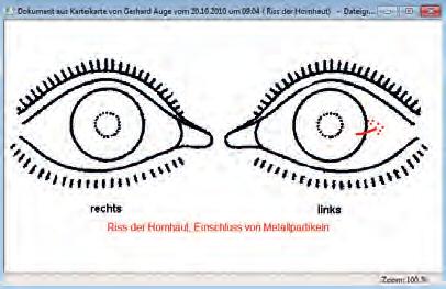 Die Lage einer Augenverletzung oder andere Befunde können so zeichnerisch erfasst werden.