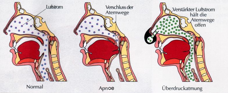 Schlafapnoe: Therapie Therapie des OSAS/der SBAS - Allgemeinmaßnahmen KG Meidung von Alkohol/Sedativa Vermeidung von Schlafdeprivation Lagetraining - Apparative