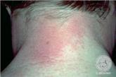 entwickeln bei Hautkontakt allergische Kontaktekzeme