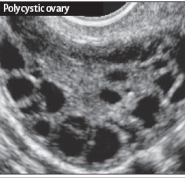 Polyzystisches Ovarsyndrom (POS) (Stein-Leventhal Syndrom) Symptome Hirsutismus Acne,