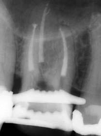 pathologische Veränderungen zu diagnostizieren. Abb. 1a: Alio loco trepanierter Zahn 16 mit obliterierten Kanalsystemen. Die Kanalstruktur ist röntgenologisch nur schwer erkennbar. Abb. 1b: Zahn 16 nach Aufbereitung und Wurzelfüllung.