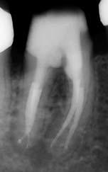 Der intraorale Befund umfasst die allgemeine zahnärztliche Untersuchung (kariöse Defekte, Füllungen, Zahnlockerungen, Taschentiefen und -sekretion, Fur - kationsbefall, Schwellungen, Lokalisation des