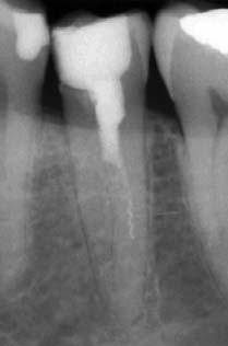 Abb. 5a Abb. 5b Abb. 6a Abb. 6b Abb. 7 Abb. 5a: Zahn 35 zeigt eine unvollständige Wurzelfüllung, welche abrupt auf halber Wurzelhöhe endet.