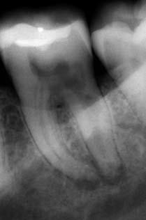 Röntgendiagnostik Mithilfe der vorangegangenen Befunde wird der betroffene Zahn oder die betroffene Region eingegrenzt, den Abschluss des Diagnostikprozesses bildet die Röntgenuntersuchung.