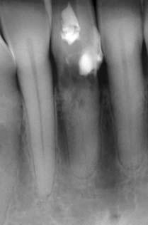 Bei bereits wurzelgefüllten Zähnen sollte eine röntgenologische Beurteilung der bestehenden Wurzel fül - lung durchgeführt werden: Wichtig ist die Beur tei lung von Homogenität, Vollständigkeit und