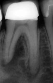 Abb. 9a: Zahn 46 mit Läsionen endodontischen Ursprungs beidseitig der mesialen Wurzelspitze. Abb.