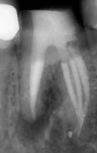 jeweiligen Patienten eine wichtige Rolle. Die endodontische und wie bereits beschrieben die präzise endodontische Dia - gnostik können eine große Herausforderung für den Behandler darstellen.