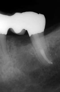 10b: Zustand nach Hemisektion der mesialen Wurzel und Revision der distalen Wurzel. Abb. 11a: Zahn 46 mit unvollständiger Wurzelfüllung. Frakturiertes Instrument in der mesialen Wurzel.